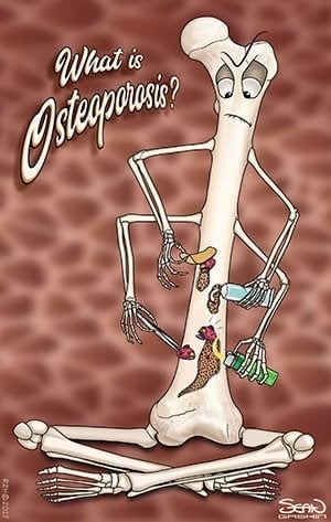 Osteoporosis: How dense are you?