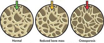 Comparative Bone Mass