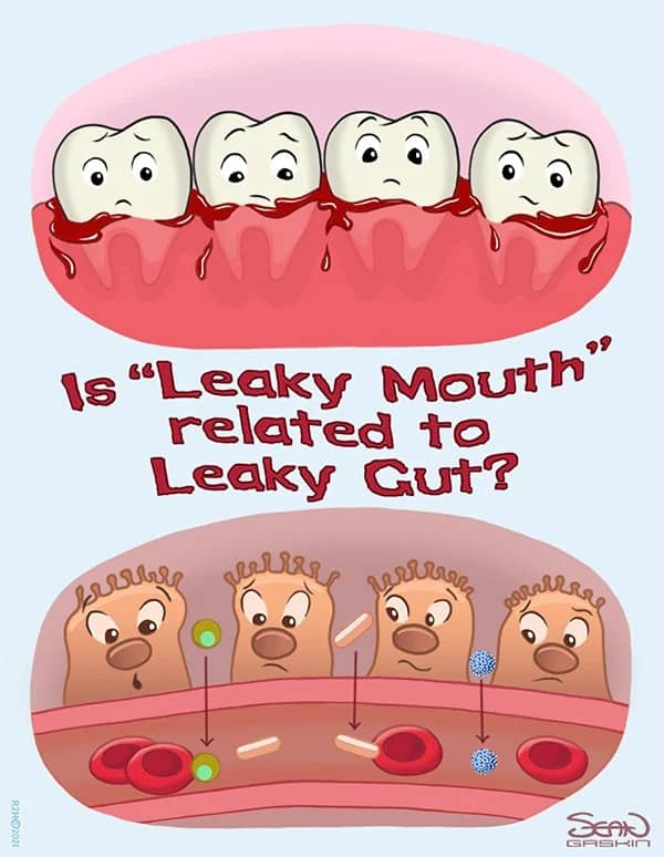 Gum Disease, Autoimmune Disorders, and Leaky Gut Syndrome:
