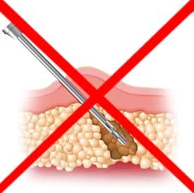 No to Liposuction