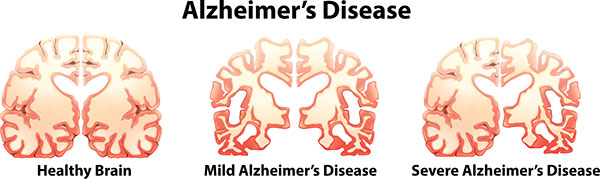 alzheimer's disease