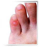 Blisters