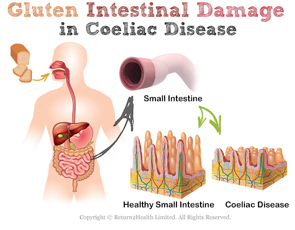 Gluten Intestinal Damage in Coeliac