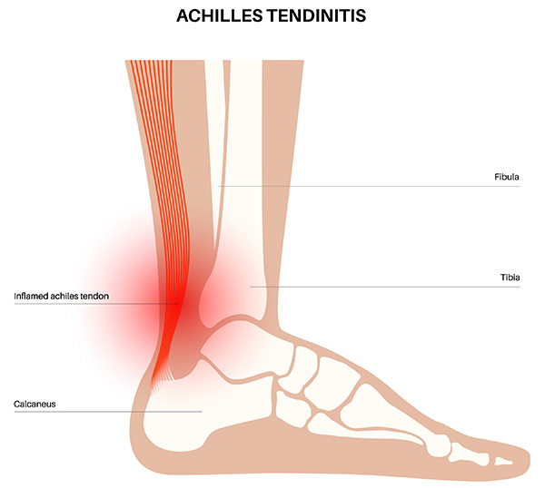 Achilles tendinitis