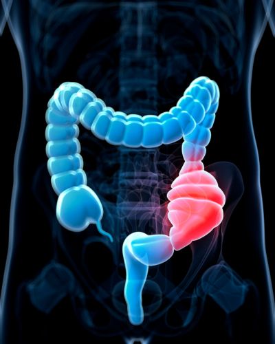 Constipated colon
