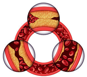 coronary-artery-disease-19355115