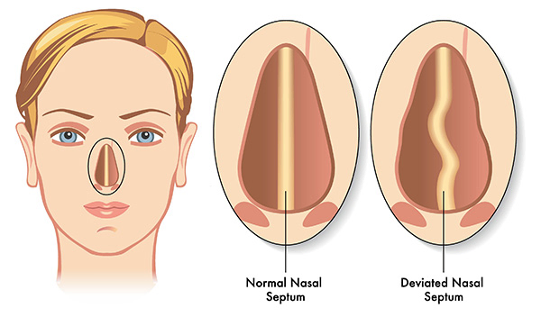 Nasal