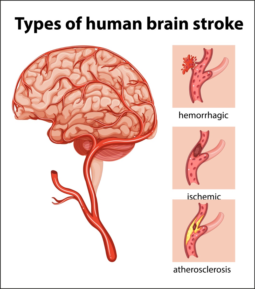 Types of Human Brain Stroke