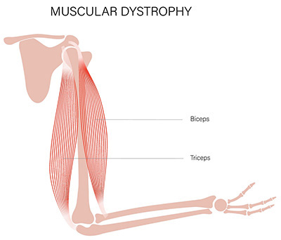 Muscular Dystrophy
