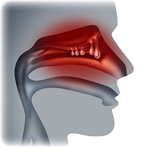 Polyps