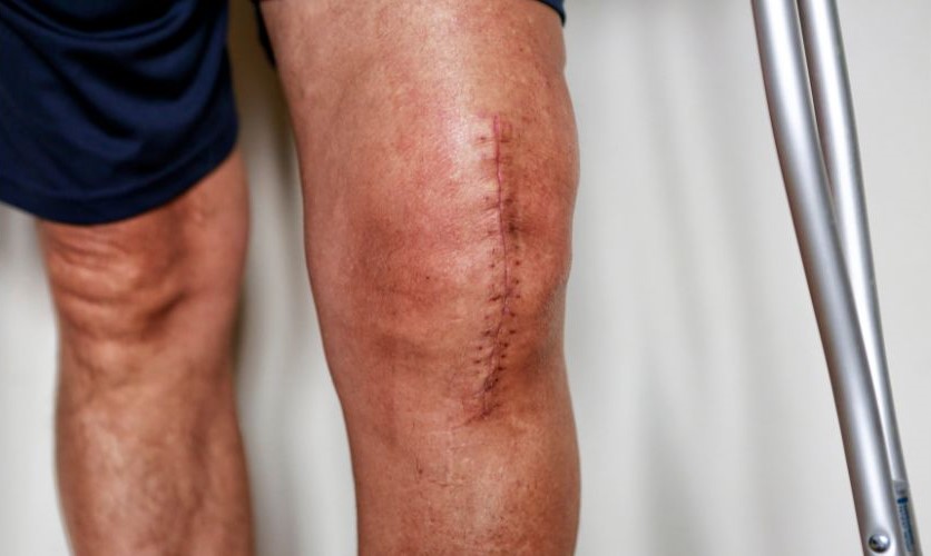 Fresh knee scar