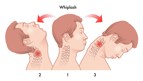 whiplash-38689654